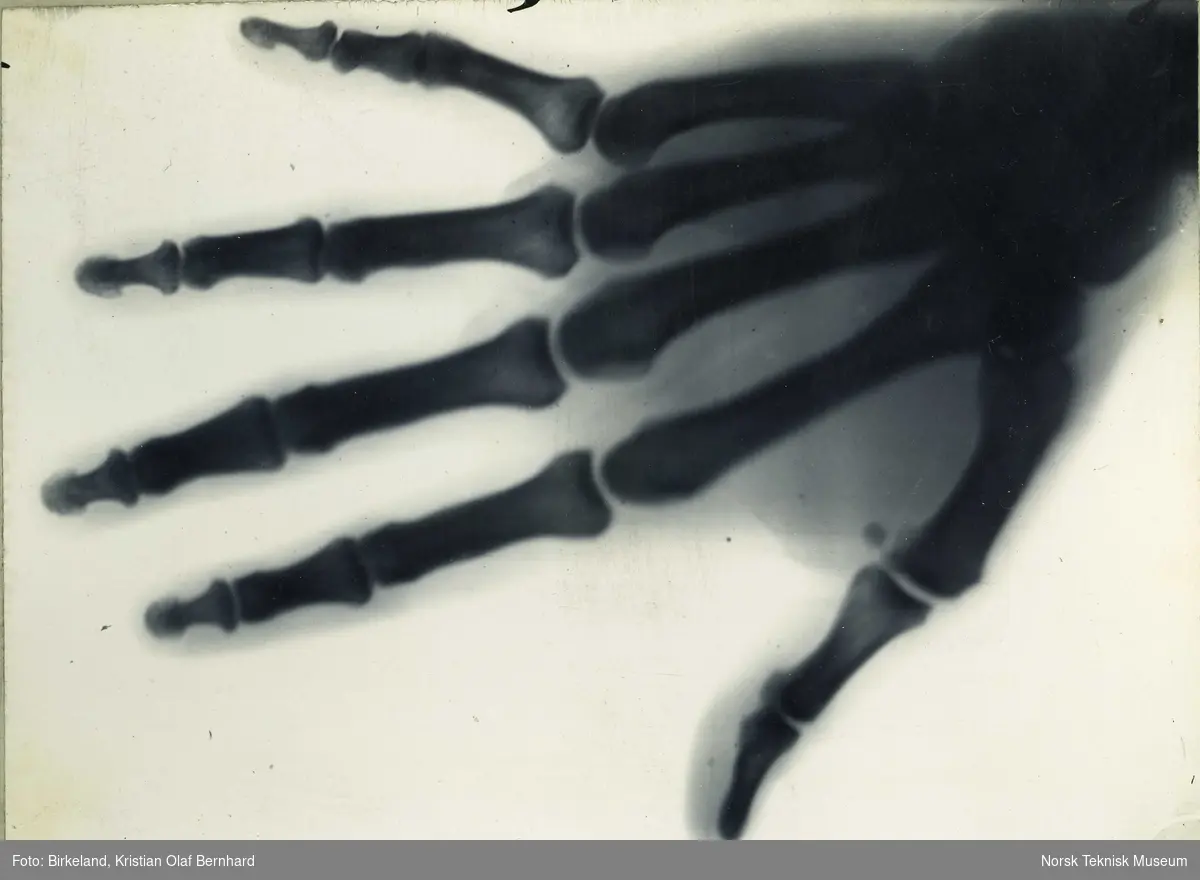 Det første røntgenfotografi tatt i Norge. Professor Torups hånd fotografert av Kristian Birkeland i februar 1896. Eksponeringstid: 5 min.