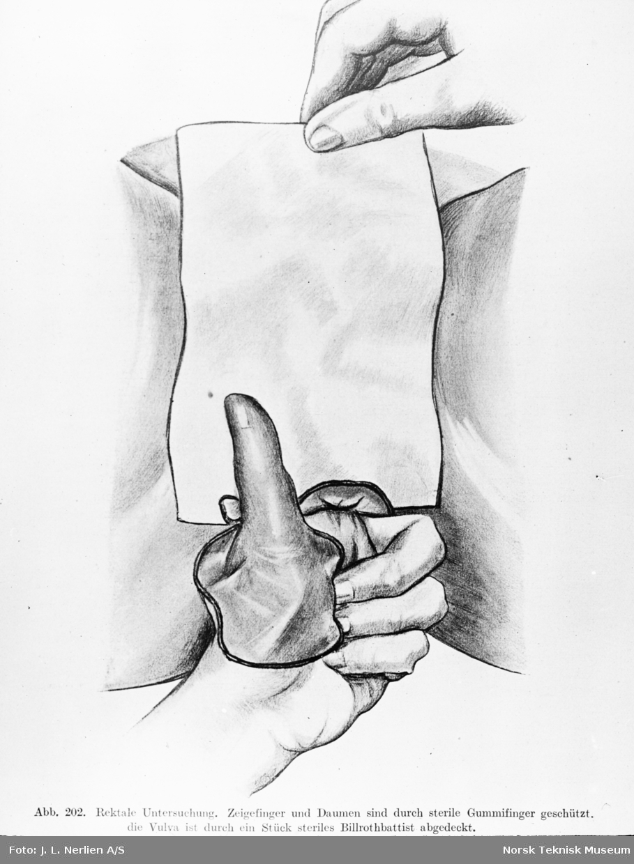 Avfotografert tegning av rektal undersøkelse, på en kvinne med pekefingeren og gummihanske, og vulvaen er dekket