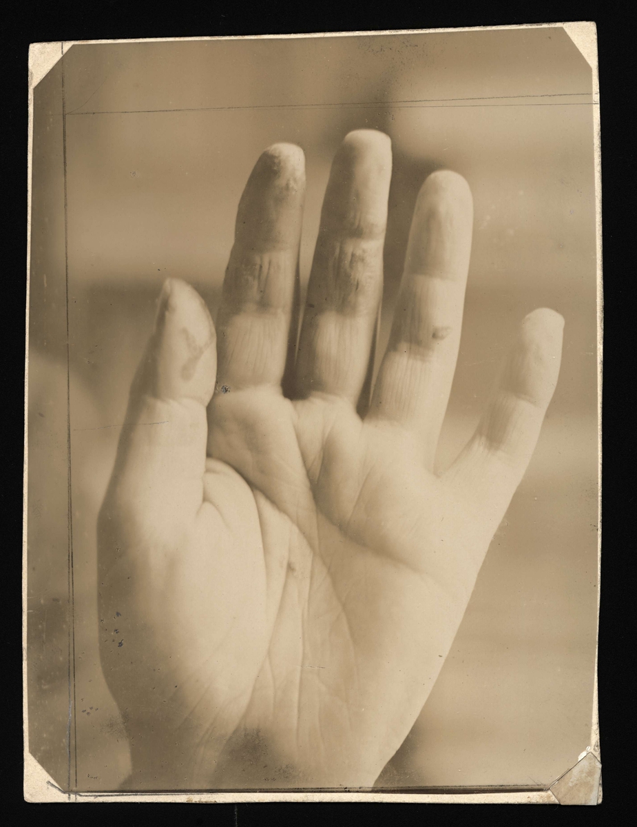 August Strindbergs hand med påskriften "Photographie aufgenommen im Hôpital Saint-Louis, Paris".